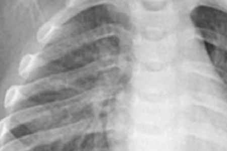 Hitro odkrivanje Chlamydia pneumoniae: zanesljivo in učinkovito